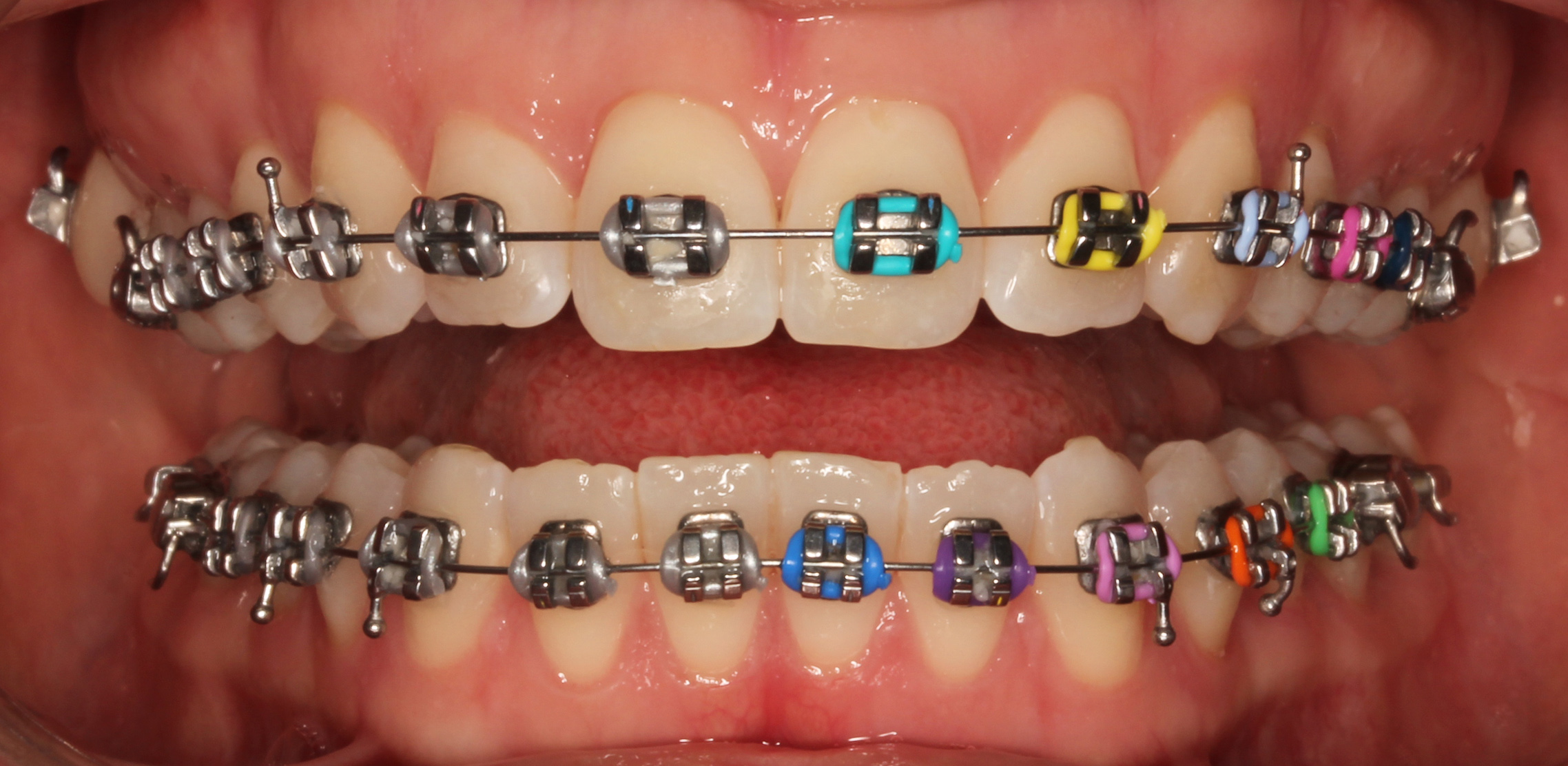 Metal Braces - Peninsula Orthodontics