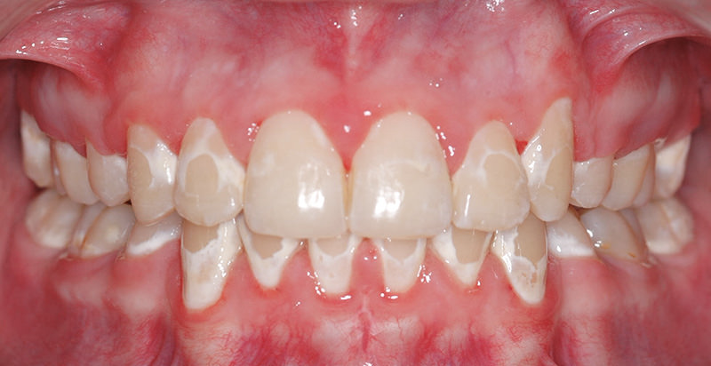 White Spots On Gums