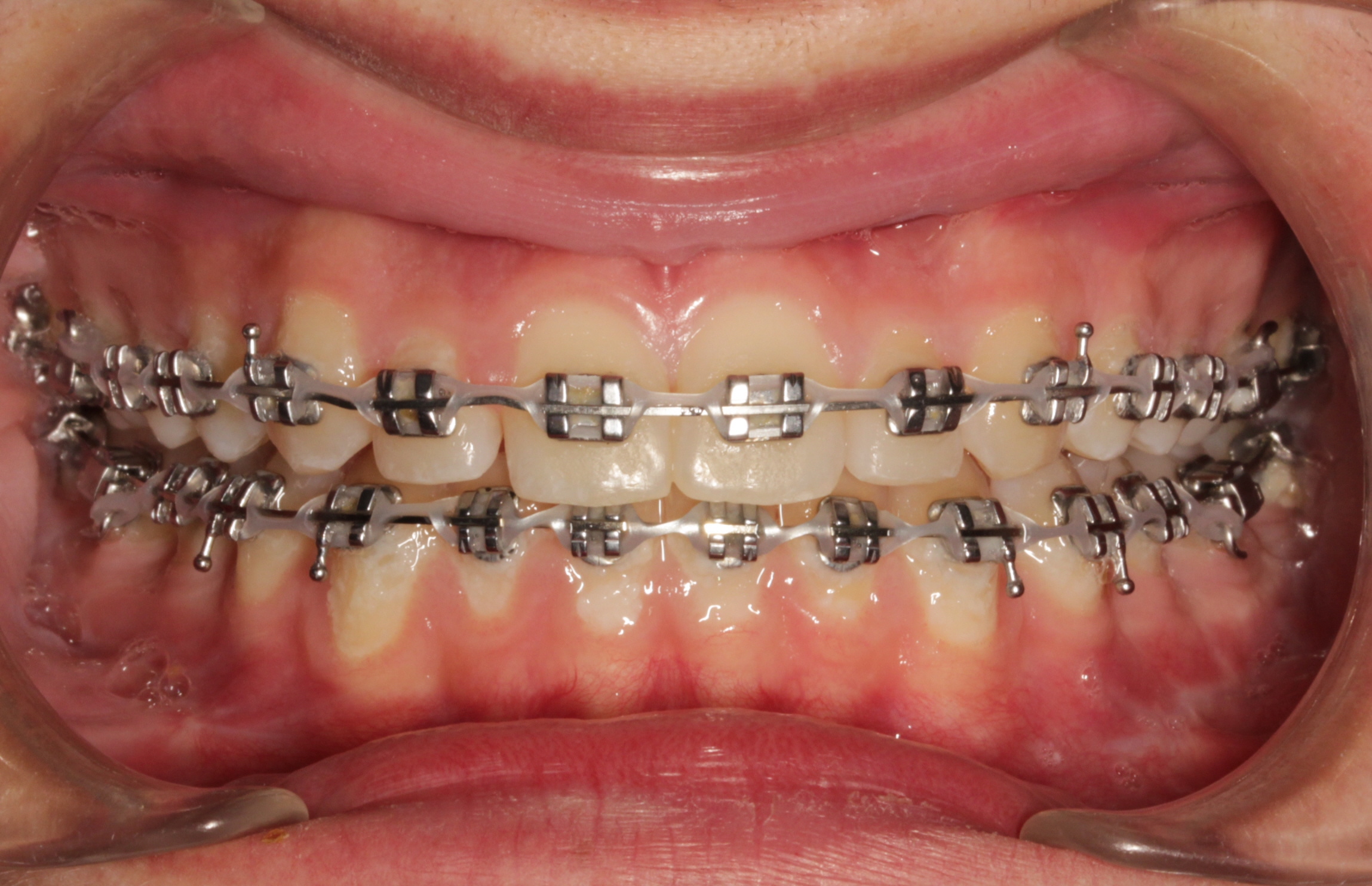 How elastics (rubber bands) SHOULD be used in orthodontics - Australian  Society of Orthodontists