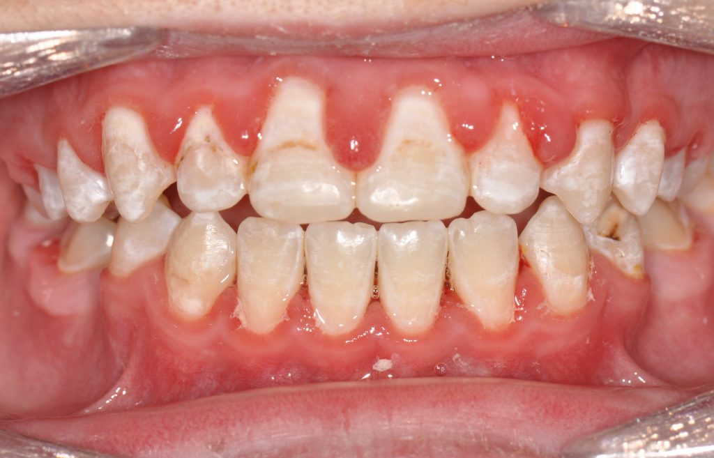 I Was Told It Is Much Easier To Get Dental Cavities With Braces On What Can I Do To Prevent It Peninsula Orthodontics